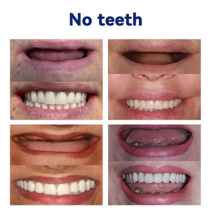 New Generation Flexible Full Denture Solution