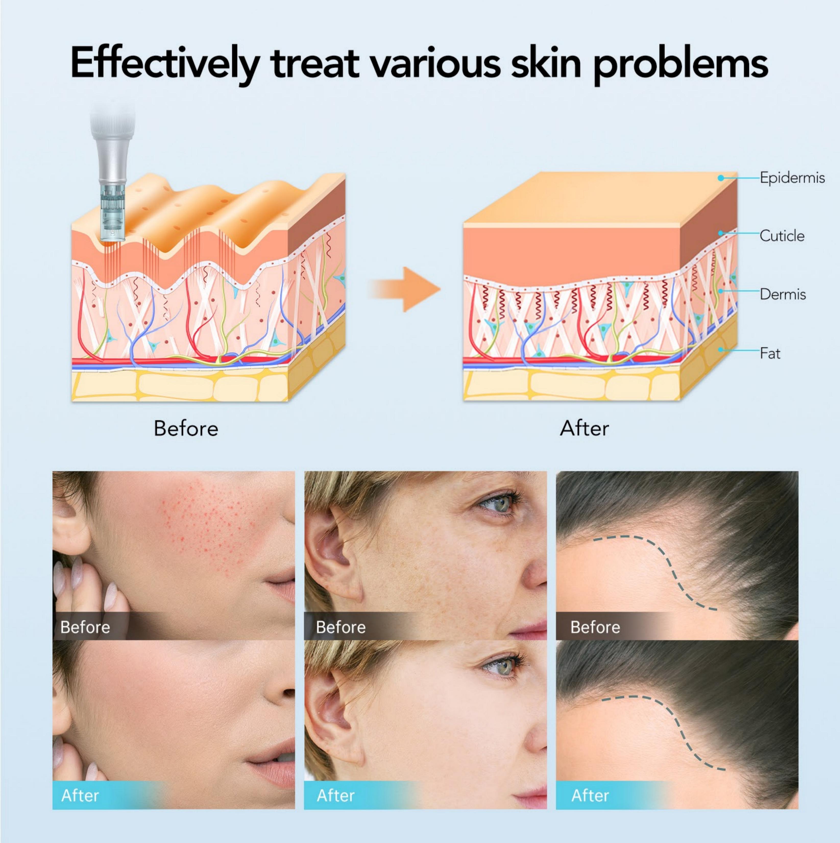 Dr Pen M7S Microneedling Pen with 12pcs Replacement Microneedles For Home Use