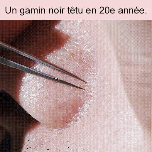 Pince à épiler pour éliminer les points noirs contre l'acné  Ensemble de 3 pièces