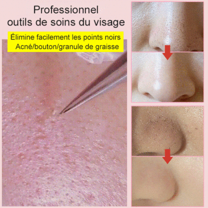 Pince à épiler pour éliminer les points noirs contre l'acné  Ensemble de 3 pièces