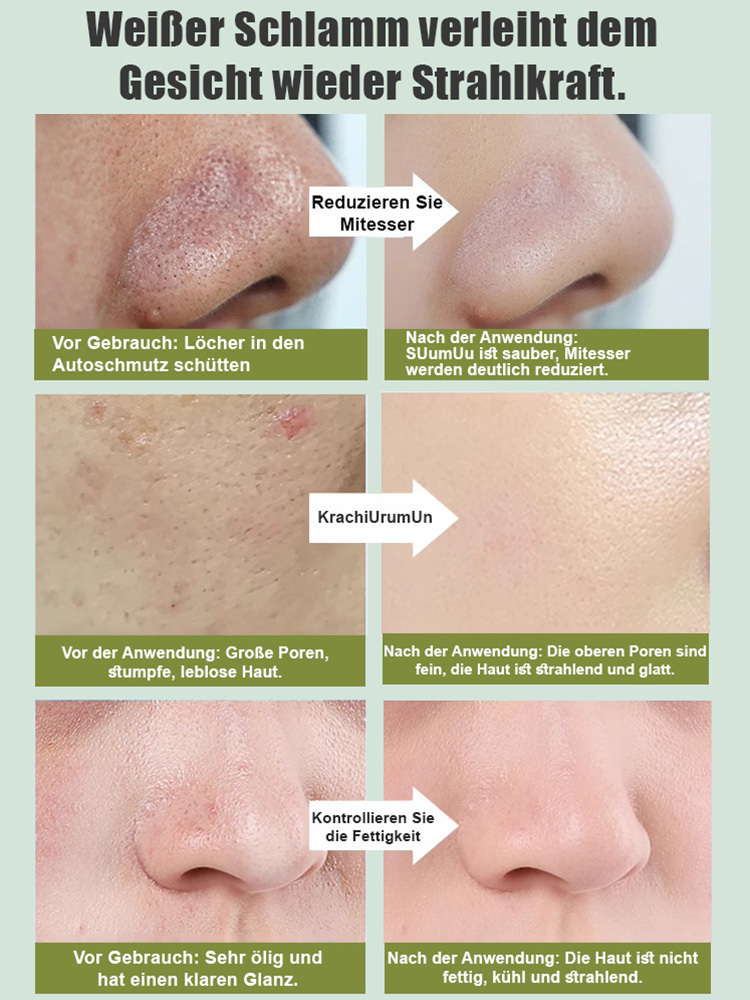 Mitesser-Entferner Porenreinigungsstreifen