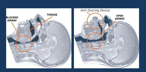 Snore Fixerr Tongue 10