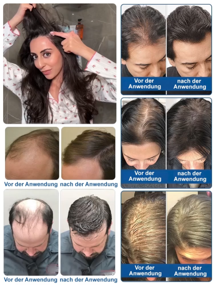 5% Minoxidil-Schaum für optimale Konzentration, sichtbare Wirkung innerhalb einer Woche 💪, das beste Mittel gegen Haarausfall im Herbst und Winter 🍂❄️