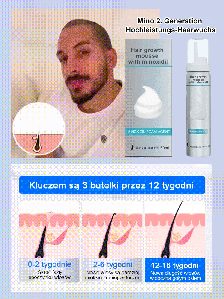 5% Minoxidil-Schaum für optimale Konzentration, sichtbare Wirkung innerhalb einer Woche 💪, das beste Mittel gegen Haarausfall im Herbst und Winter 🍂❄️