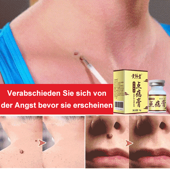 Von Ärzten empfohlen - Warzenentfernungscreme, entfernt Warzen leicht, ohne Narben zu hinterlassen