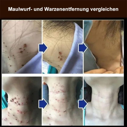 Von Ärzten empfohlen - Warzenentfernungscreme, entfernt Warzen leicht, ohne Narben zu hinterlassen