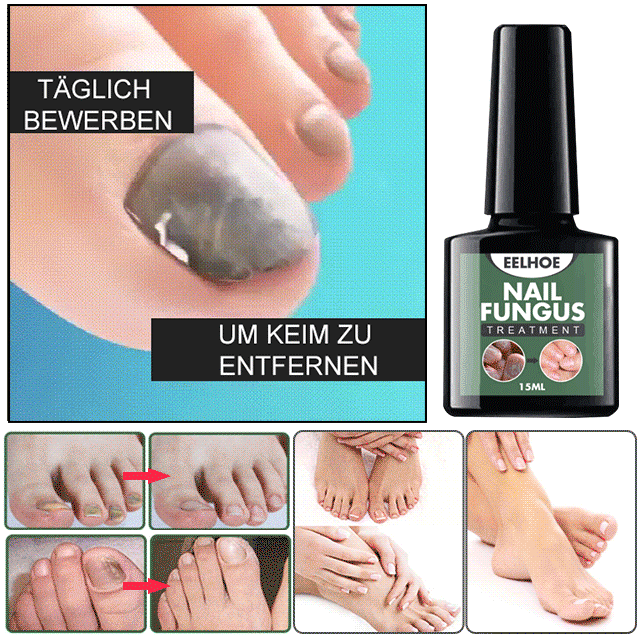 Onychomykose-Behandlungslösung, tiefe Reparatur, schmerzlos und kein Wiederauftreten