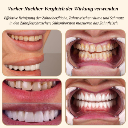 [Von Zahnärzten entwickelt] 10-Sekunden-vollautomatische, faule U-förmige elektrische Zahnbürste