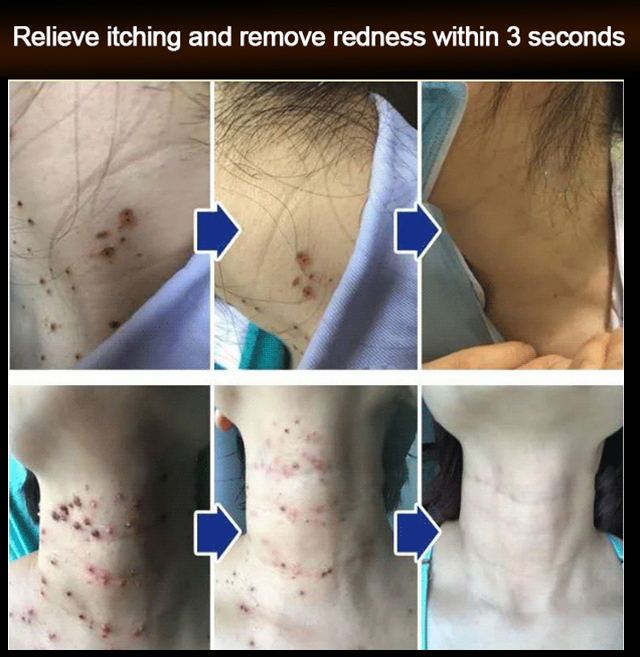 [Buy 1 Free 1]Spots and moles removal essence