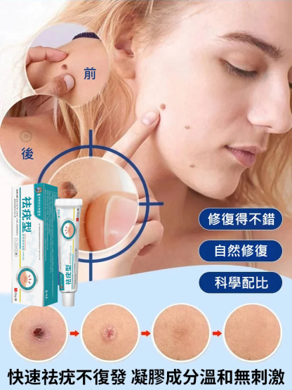 【除疣一抹靈】醫用退熱凝膠疣清寧！祛疣率高達99.99%，自然無痛脫落不留疤！