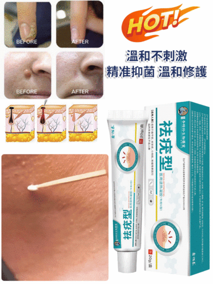 【除疣一抹靈】醫用退熱凝膠疣清寧！祛疣率高達99.99%，自然無痛脫落不留疤！
