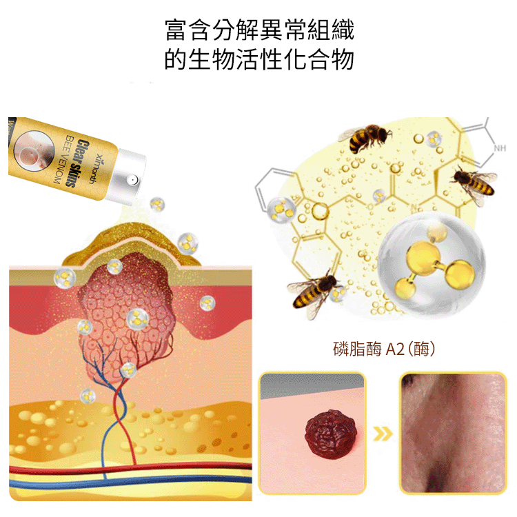 蜂毒克疣護理噴霧