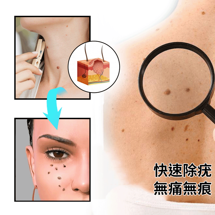 蜂毒克疣護理噴霧