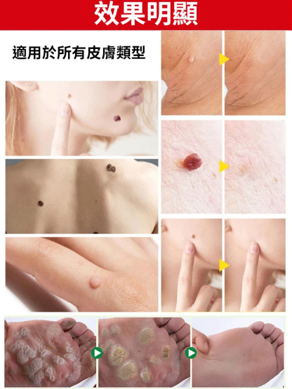 【除疣一抹靈】醫用退熱凝膠疣清寧！祛疣率高達99.99%，自然無痛脫落不留疤！
