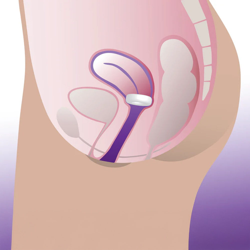 ProFem Donut Pessary