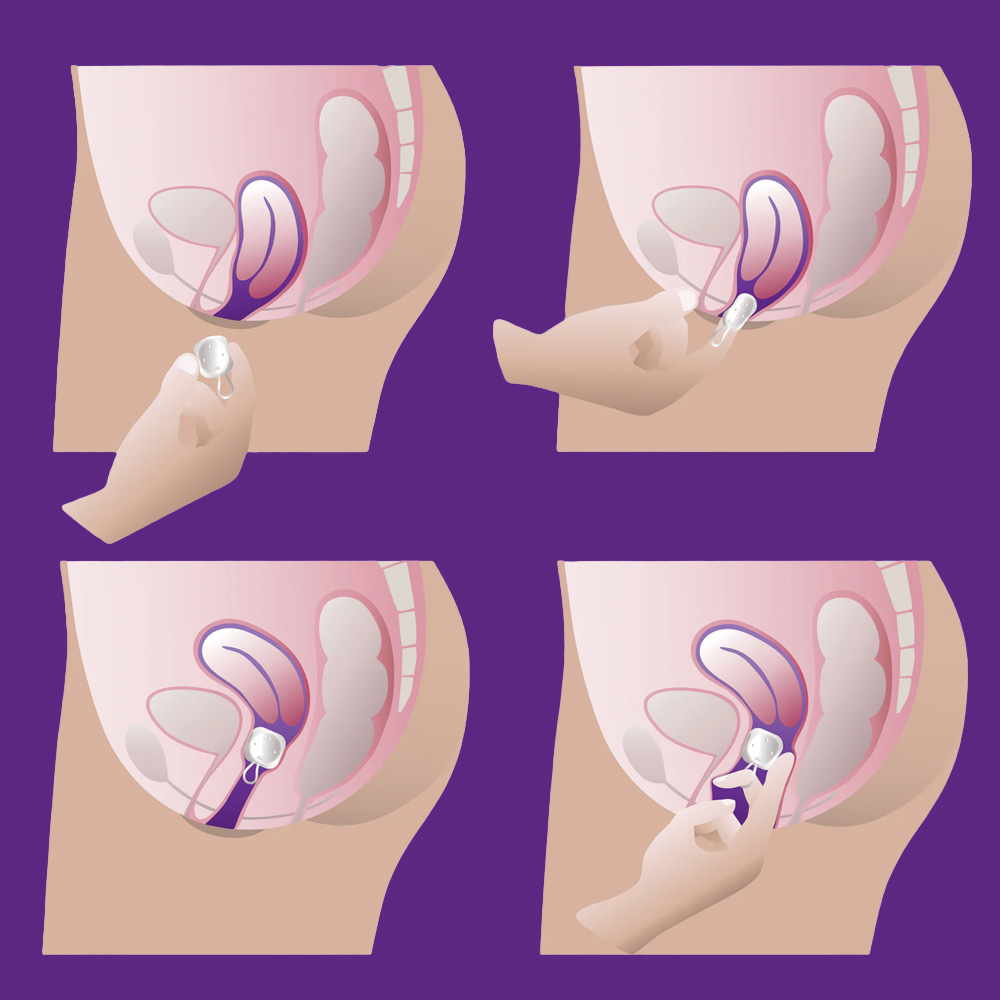 ProFem Cube Pessary With Drains For Prolapse