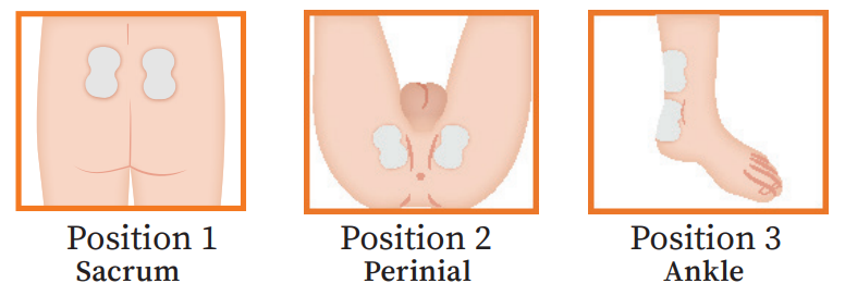Where to Place Tens Pads for Pelvic Floor: Expert Tips