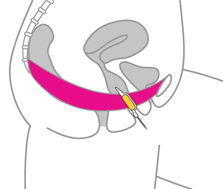 Kegel8 Water Test - Correct Probe Position