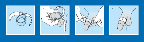 Prosecca Penile Clamp &ndash; Discreet Support for Male Urinary Incontinence