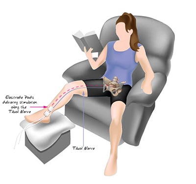 Kegel8 Tibial Nerve Stimulation