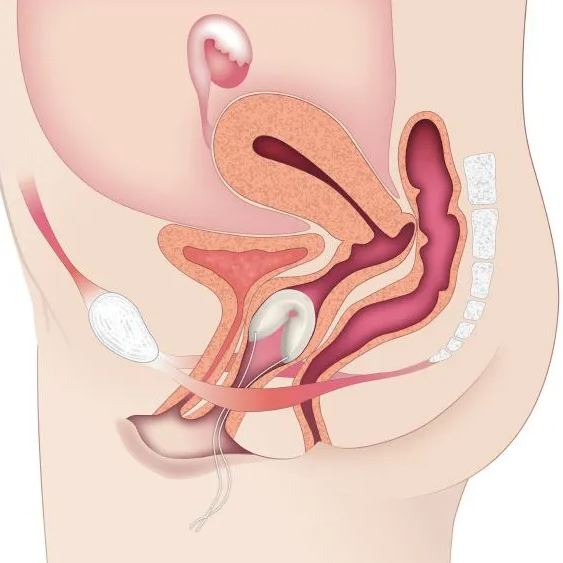 Contrelle Activguard Bladder Support Pessary