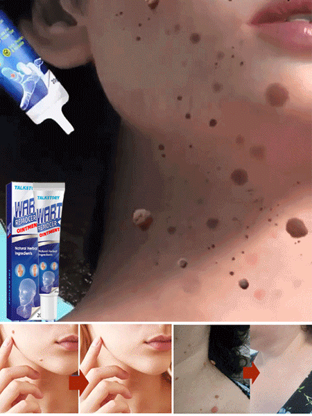 Creme zur Warzenentfernung