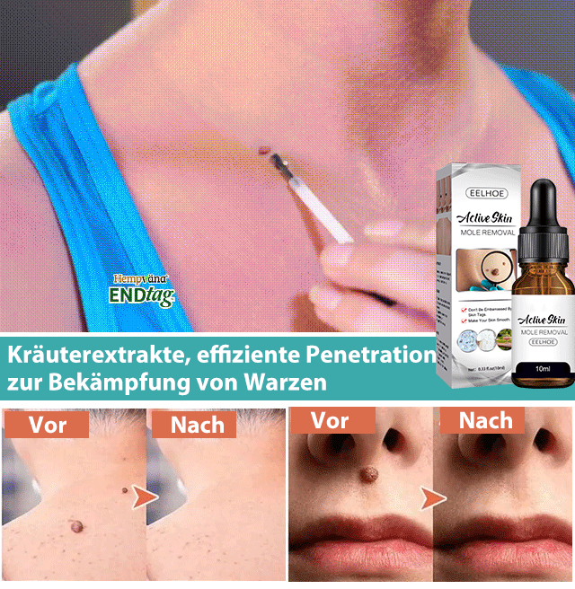 Warzen-Serum