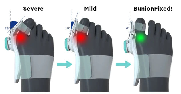 Upgraded Bunion Corrector - 3D Knob Toes Corrector