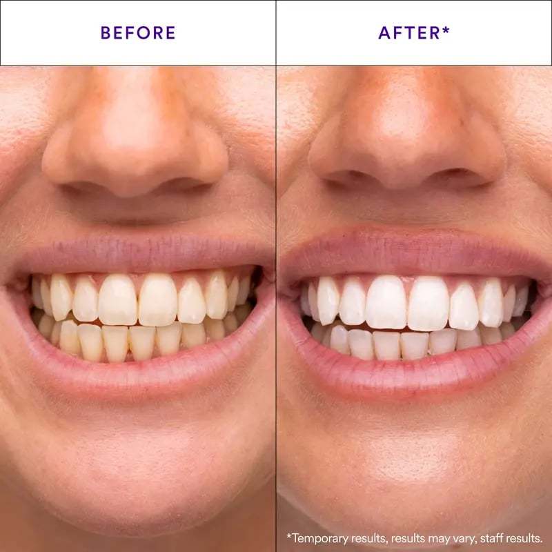 Hismile V34 Whitening Strips