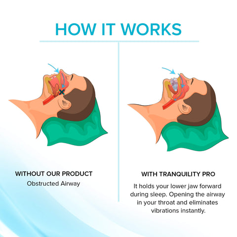 Adjustable Anti-Snoring Mouthpiece