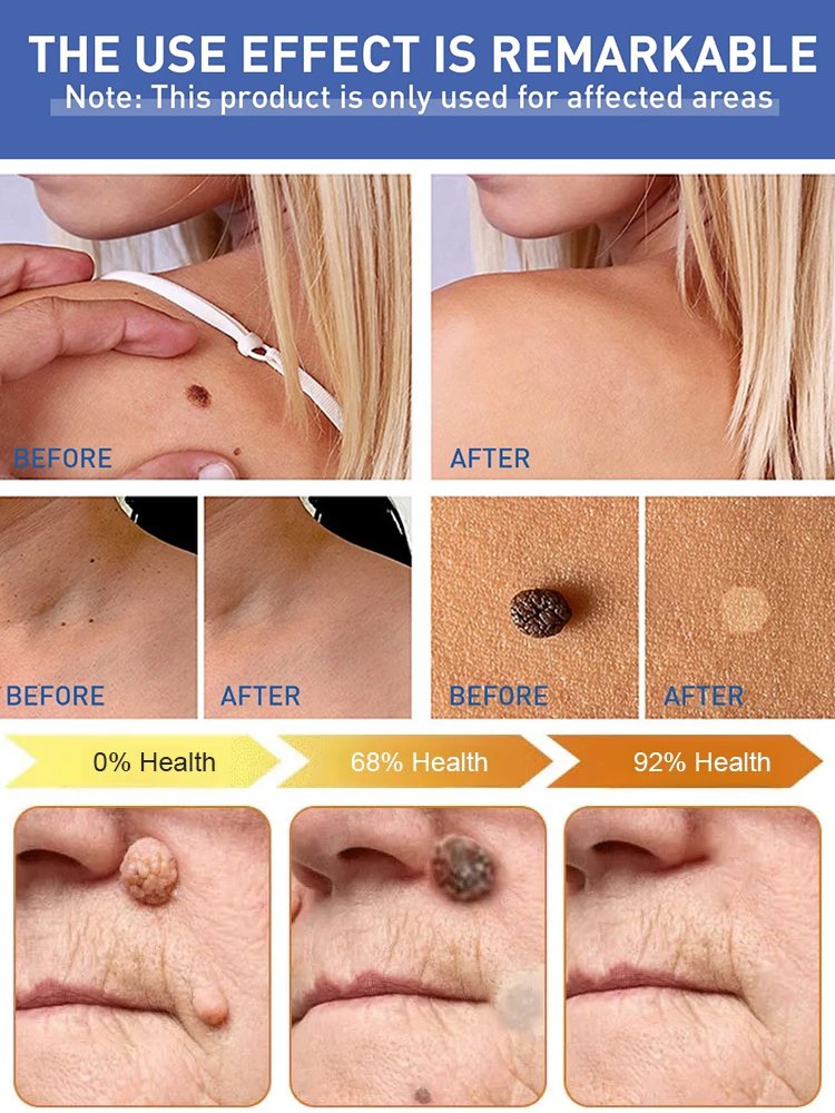 Herbal Mint Body Wart Cream