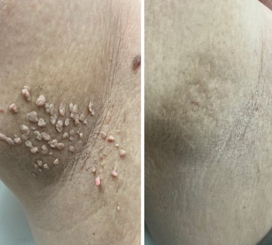 skin tag removal before and after