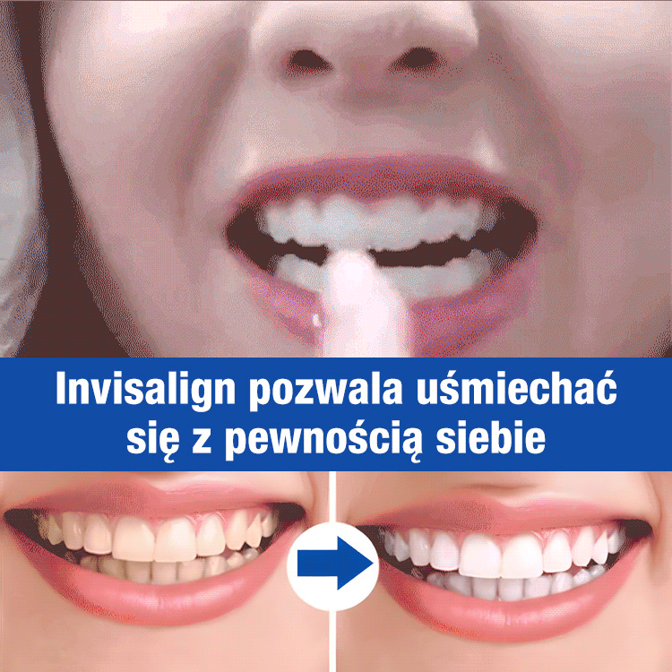 Symulacyjne silikonowe nakładki na zęby