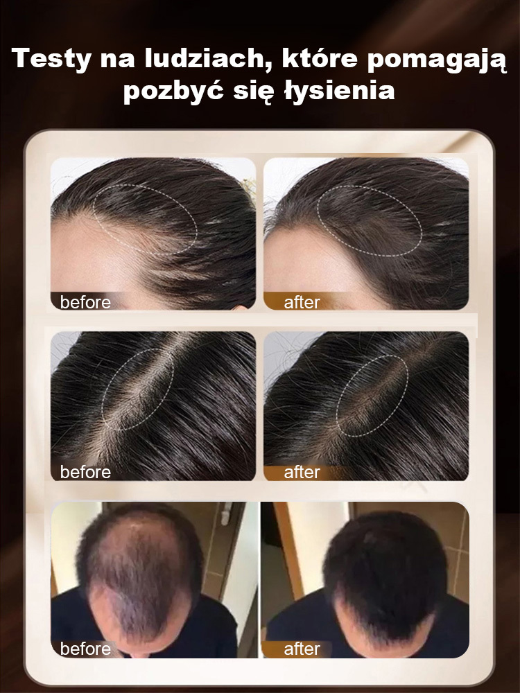 Nadal zmagasz się z wypadaniem włosów? 【Rekomendacja ekspertów】 Przywraca młodzieńczą teksturę włosów, zapewniając im zdrowe, grubsze włosy.