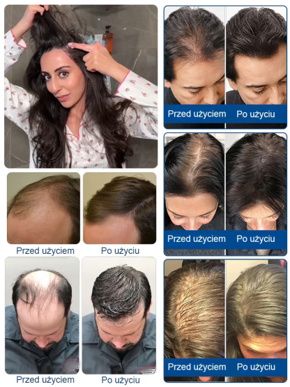 5% najlepiej skoncentrowana pianka minoksydylowa, efekty widoczne w ciągu tygodnia, odzyskaj swoje piękne włosy! 🌟💁‍♂️💁‍♀️