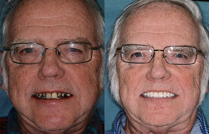 Hidone®Advanced Denture Kit with Custom Dentures