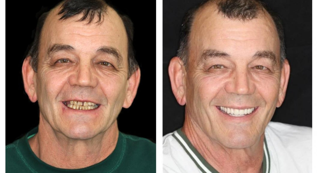 Hidone®Advanced Denture Kit with Custom Dentures