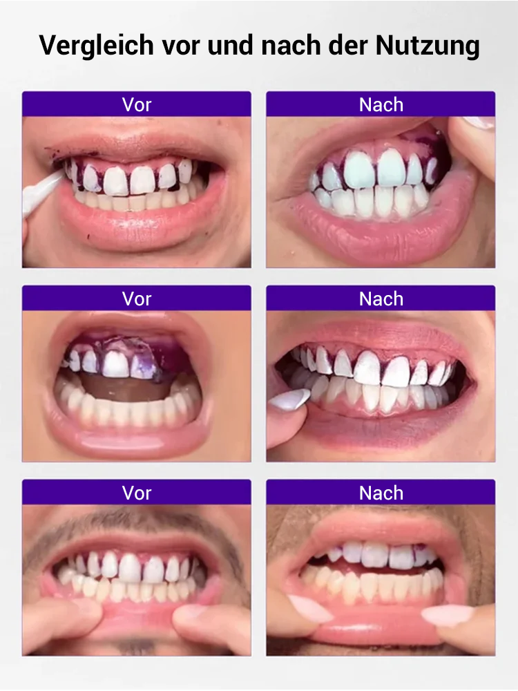 Aufhellende und fleckenentfernende violette Zahnaufhellungsstreifen