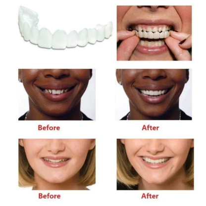 🔥 Last Day 75% OFF - Latest👨‍⚕Adjustable Snap-On Dentures