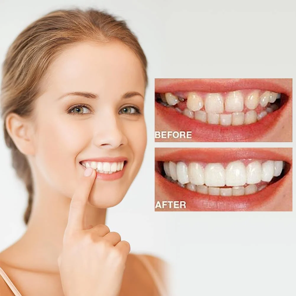 🔥 Last Day 75% OFF - Latest👨‍⚕Adjustable Snap-On Dentures