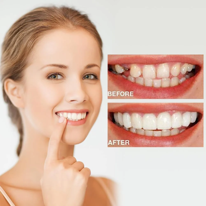 🔥 Last Day 75% OFF - Latest👨‍⚕Adjustable Snap-On Dentures