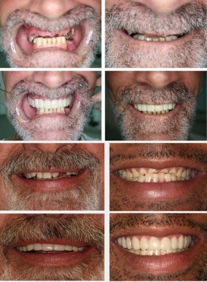 🔥 Last Day 49% OFF - Latest👨‍⚕Adjustable Snap-On Dentures