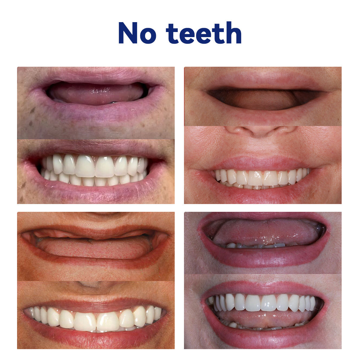 PosrystTM Silicone Reline Denture Set🦷(👩‍🔬CED Compliant Approved By Professional Dentists)