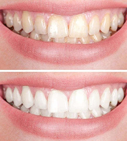 1+1 FREE | Teeth Whitener