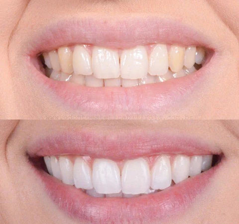 1+1 FREE | Teeth Whitener