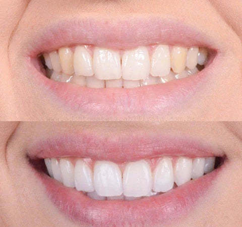 1+1 FREE | Teeth Whitener