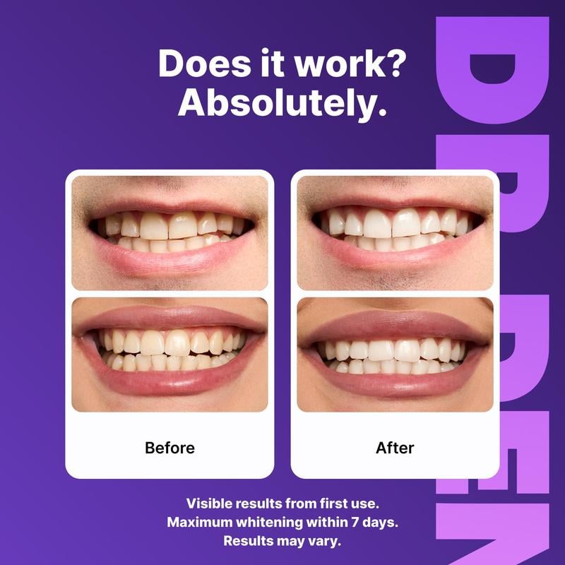 ✨🦷 DR.DENT Purple Teeth Whitening Strips (30-Minute Instant Brightening)