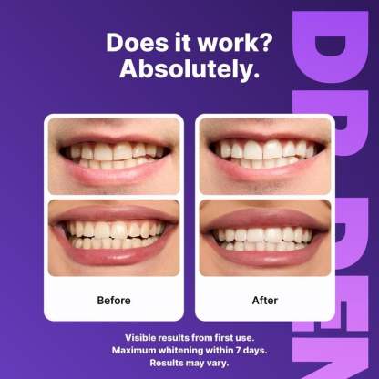 ✨🦷 DR.DENT Purple Teeth Whitening Strips (30-Minute Instant Brightening)