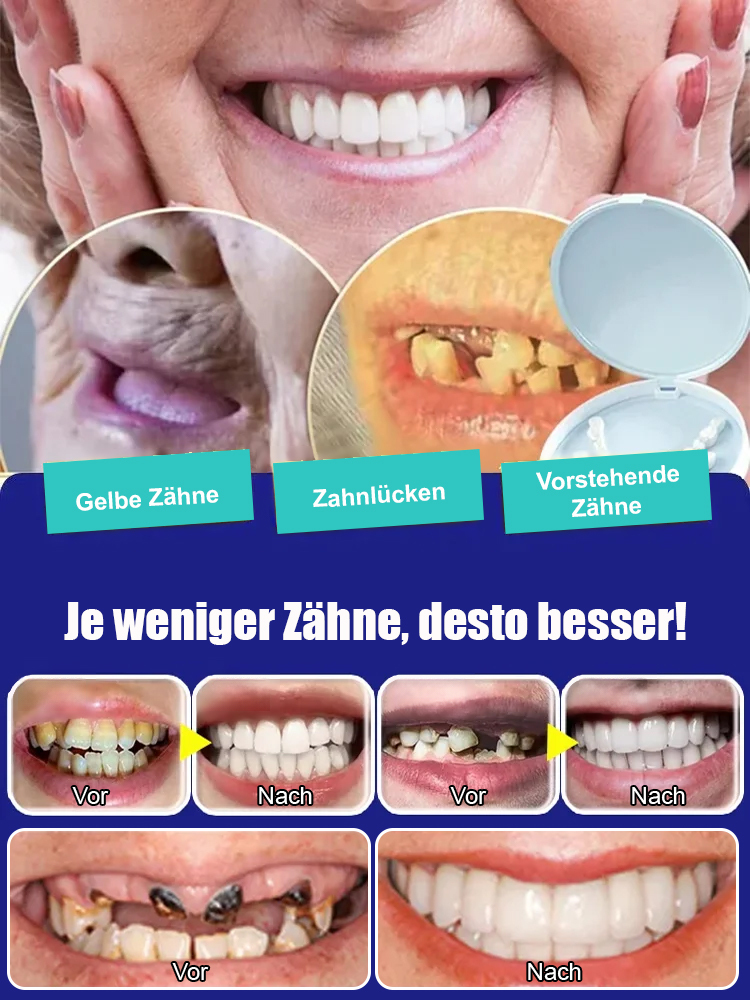 Zahnersatzverblendung