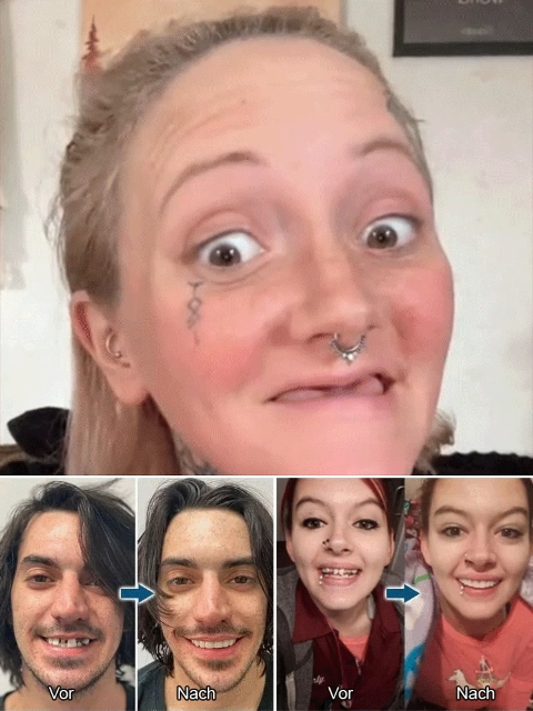 【🦷 Simulated All-Ceramic Dentures】💖 Pain-free wear, perfect fit for the mouth - ✨ Does not irritate gums or affect eating - 💯 Indistinguishable from real teeth